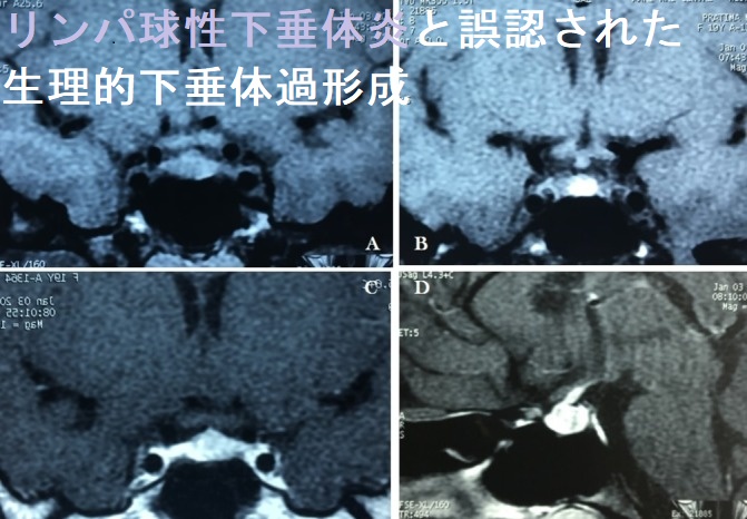 リンパ球性下垂体炎と誤認された生理的下垂体過形成 リンパ球性下垂体炎と誤認された生理的下垂体過形成