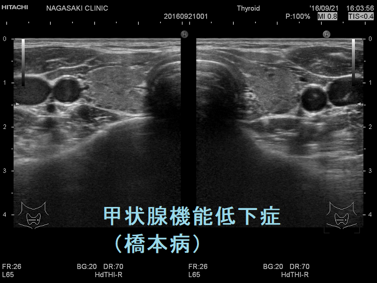 甲状腺機能低下症（橋本病）超音波(エコー)画像