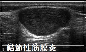 結節性筋膜炎 超音波(エコー)画像
