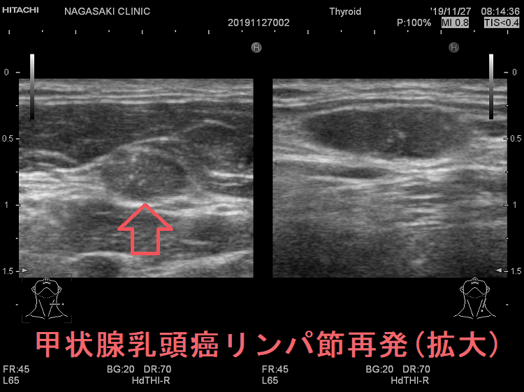 甲状腺乳頭癌のリンパ節再発（拡大） 超音波エコー画像