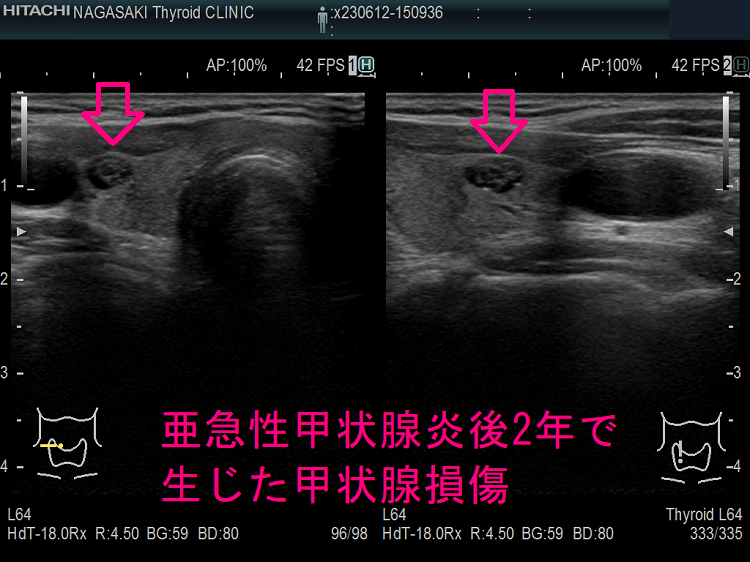 亜急性甲状腺炎後2年で生じた甲状腺損傷 超音波(エコー)画像