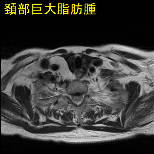 頚部巨大脂肪腫 MRI 画像(水平断)2 頚部巨大脂肪腫 MRI 画像(水平断)2