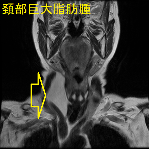 頚部巨大脂肪腫 MRI 画像(冠状断)1 頚部巨大脂肪腫 MRI 画像(冠状断)1