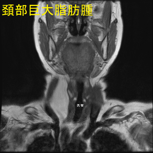 頚部巨大脂肪腫 MRI 画像(冠状断)2 頚部巨大脂肪腫 MRI 画像(冠状断)2