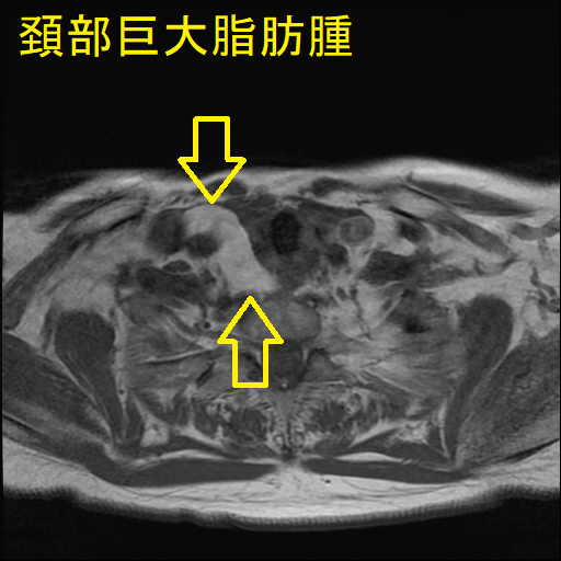 頚部巨大脂肪腫 MRI 画像(水平断)1 頚部巨大脂肪腫 MRI 画像(水平断)1