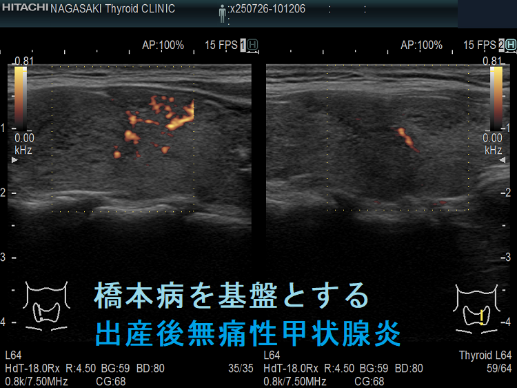 橋本病を基盤とする出産後無痛性甲状腺炎(矢状断)ドプラーモード 橋本病を基盤とする出産後無痛性甲状腺炎(矢状断)ドプラーモード