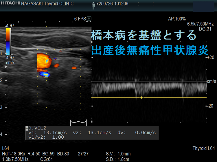 橋本病を基盤とする出産後無痛性甲状腺炎 ITA-PSV 橋本病を基盤とする出産後無痛性甲状腺炎 ITA-PSV