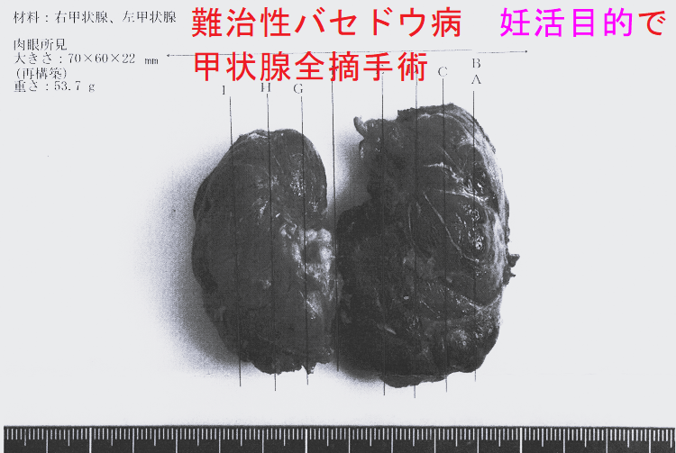 難治性バセドウ病 妊活目的で甲状腺全摘手術標本(表) 難治性バセドウ病 妊活目的で甲状腺全摘手術標本(表)