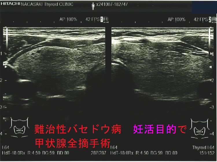 難治性バセドウ病 妊活目的で甲状腺全摘手術標本(表) 難治性バセドウ病 妊活目的で甲状腺全摘手術1