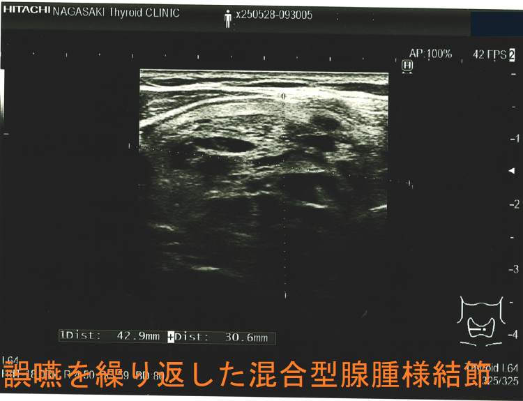 誤嚥を繰り返した混合型腺腫様結節 超音波(エコー)画像 (水平断) 誤嚥を繰り返した混合型腺腫様結節 超音波(エコー)画像 (水平断)