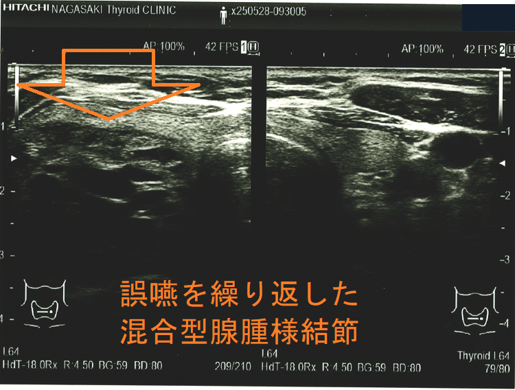 誤嚥を繰り返した混合型腺腫様結節 超音波(エコー)画像 誤嚥を繰り返した混合型腺腫様結節 超音波(エコー)画像
