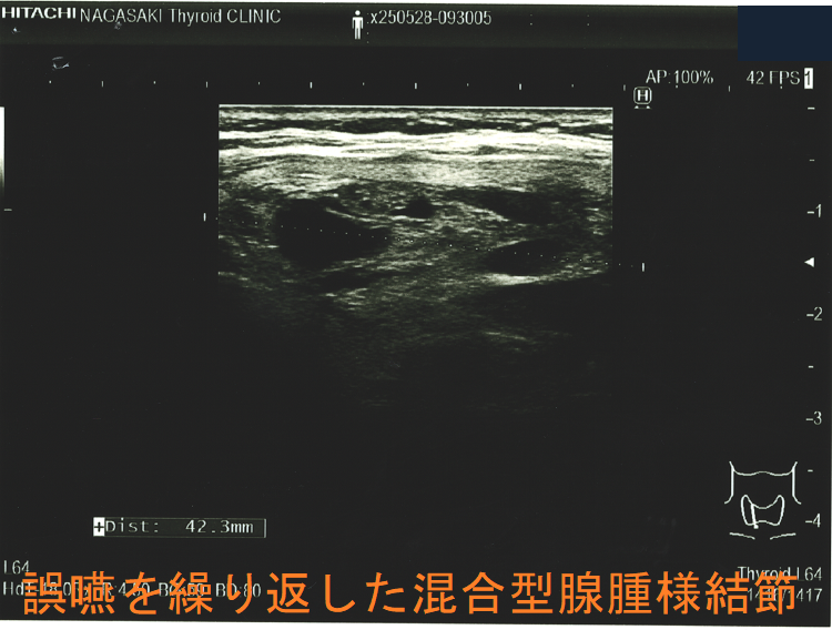誤嚥を繰り返した混合型腺腫様結節 超音波(エコー)画像 (矢状断) 誤嚥を繰り返した混合型腺腫様結節 超音波(エコー)画像 (矢状断)