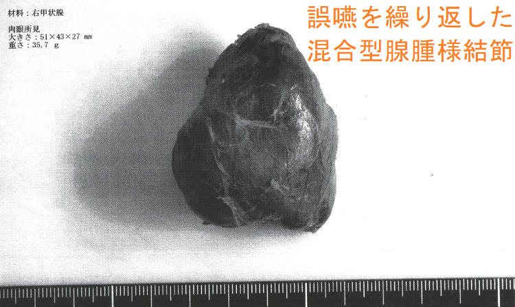 誤嚥を繰り返した混合型腺腫様結節 摘出標本 誤嚥を繰り返した混合型腺腫様結節 摘出標本