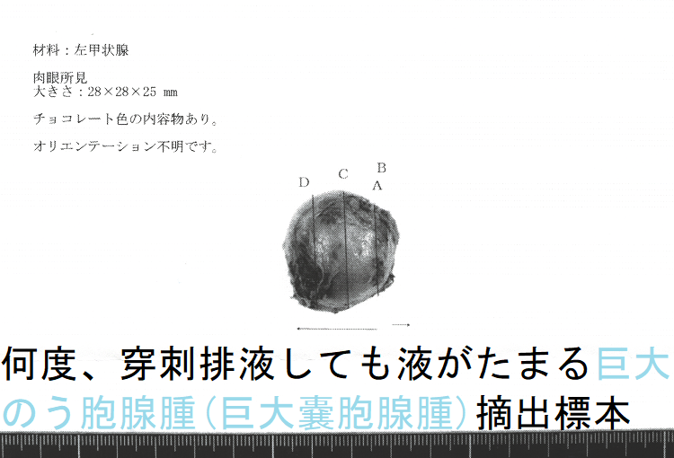 何度、穿刺排液しても液がたまる巨大のう胞腺腫(巨大嚢胞腺腫)摘出標本(表面) 何度、穿刺排液しても液がたまる巨大のう胞腺腫(巨大嚢胞腺腫)摘出標本(表面)