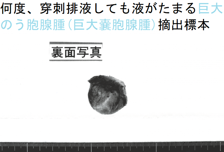 何度、穿刺排液しても液がたまる巨大のう胞腺腫(巨大嚢胞腺腫)摘出標本(裏面) 何度、穿刺排液しても液がたまる巨大のう胞腺腫(巨大嚢胞腺腫)摘出標本(裏面)