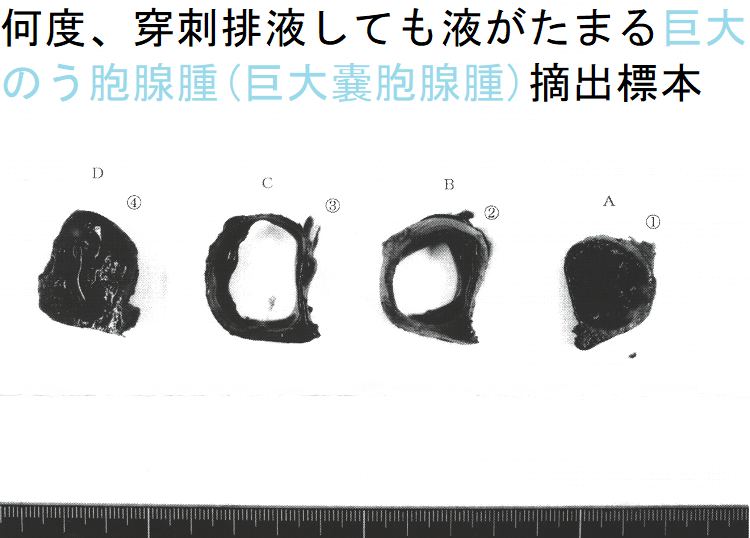 何度、穿刺排液しても液がたまる巨大のう胞腺腫(巨大嚢胞腺腫)摘出標本(割面) 何度、穿刺排液しても液がたまる巨大のう胞腺腫(巨大嚢胞腺腫)摘出標本(割面)