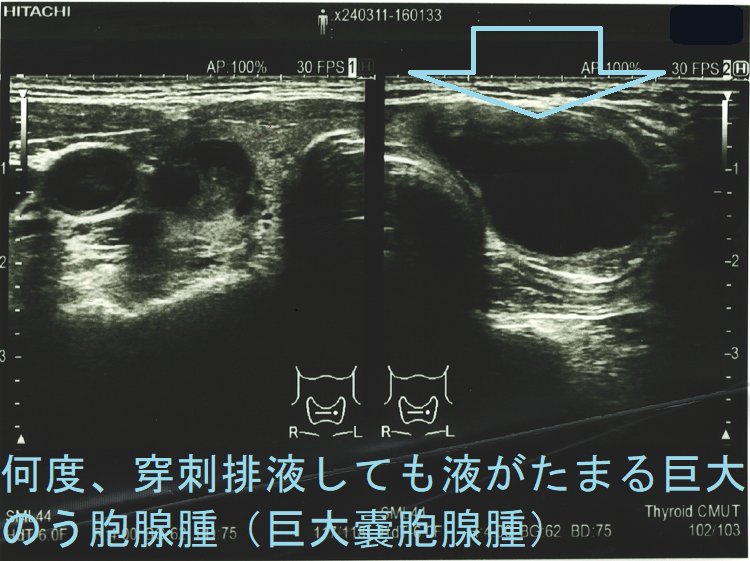 何度、穿刺排液しても液がたまる巨大のう胞腺腫(巨大嚢胞腺腫)超音波(エコー)画像 何度、穿刺排液しても液がたまる巨大のう胞腺腫(巨大嚢胞腺腫)超音波(エコー)画像