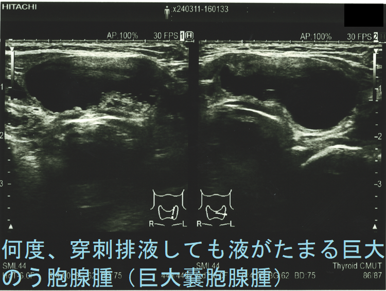 何度、穿刺排液しても液がたまる巨大のう胞腺腫(巨大嚢胞腺腫)超音波(エコー)画像2 何度、穿刺排液しても液がたまる巨大のう胞腺腫(巨大嚢胞腺腫)超音波(エコー)画像2