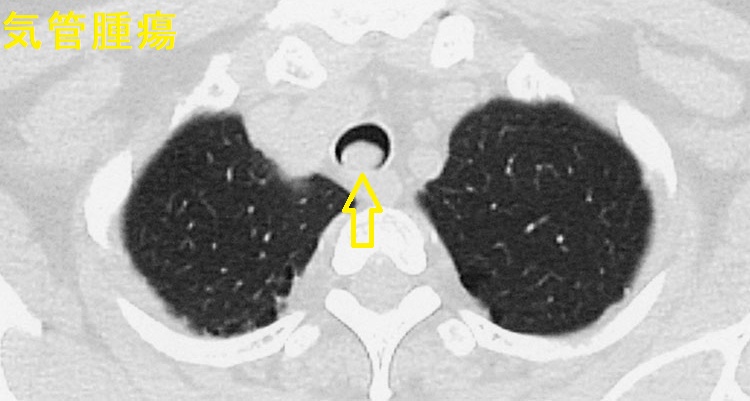 気管腫瘍 胸部単純CT 気管腫瘍 胸部単純CT
