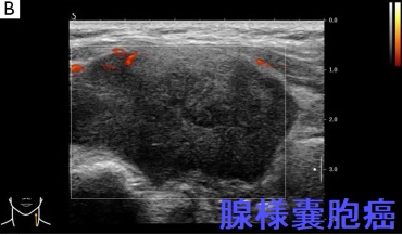 甲状腺浸潤して甲状腺腫瘍のように見えた腺様嚢胞癌 超音波(エコー)画像 甲状腺浸潤して甲状腺腫瘍のように見えた腺様嚢胞癌 超音波(エコー)画像