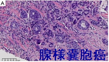甲状腺浸潤して甲状腺腫瘍のように見えた腺様嚢胞癌 組織像 甲状腺浸潤して甲状腺腫瘍のように見えた腺様嚢胞癌 組織像