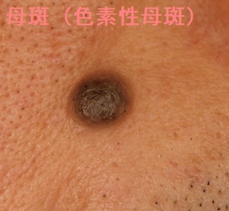 母斑(色素性母斑) 母斑(色素性母斑)