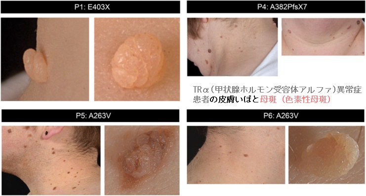 TRα(甲状腺ホルモン受容体アルファ)異常症の皮膚いぼと母斑(色素性母斑) TRα(甲状腺ホルモン受容体アルファ)異常症の皮膚いぼと母斑(色素性母斑)
