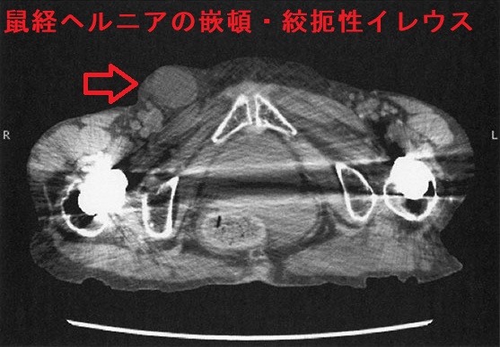鼠経ヘルニアの嵌頓・絞扼性イレウス 骨盤部単純CT 1 鼠経ヘルニアの嵌頓・絞扼性イレウス 骨盤部単純CT 1