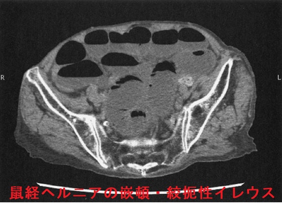 鼠経ヘルニアの嵌頓・絞扼性イレウス 骨盤部単純CT 2 鼠経ヘルニアの嵌頓・絞扼性イレウス 骨盤部単純CT 2