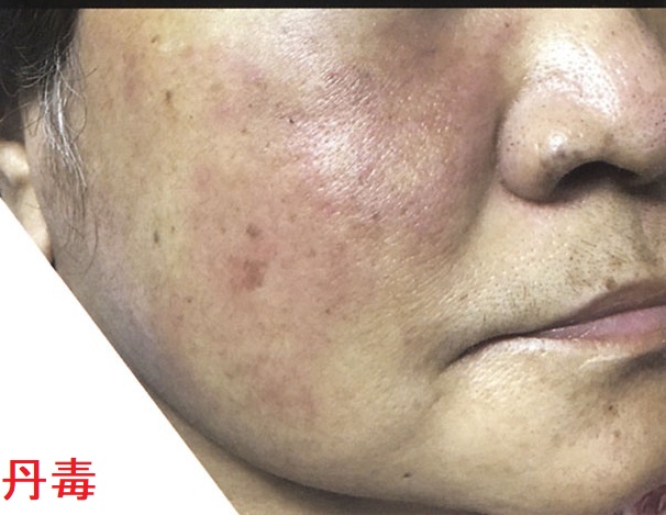 丹毒 丹毒