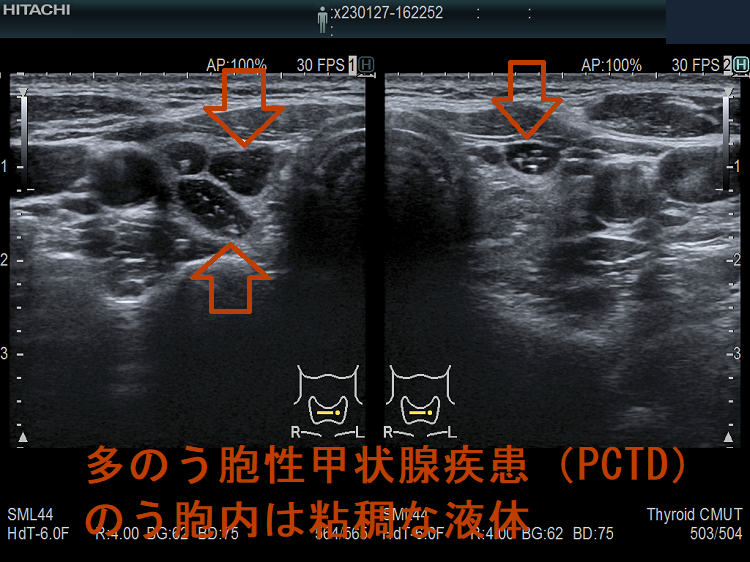 多のう胞性甲状腺疾患（PCTD） 超音波(エコー)画像 のう胞内は粘稠な液体（水平断）