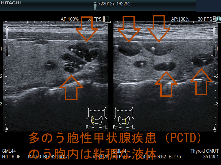 多のう胞性甲状腺疾患（PCTD） 超音波(エコー)画像 のう胞内は粘稠な液体（垂直断）