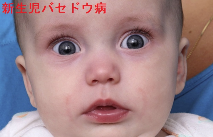 新生児バセドウ病 新生児バセドウ病