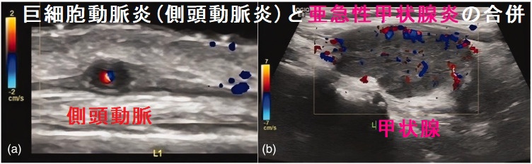 巨細胞動脈炎(側頭動脈炎)と亜急性甲状腺炎の合併 巨細胞動脈炎(側頭動脈炎)と亜急性甲状腺炎の合併