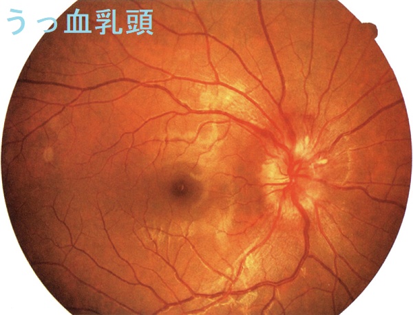 うっ血乳頭 うっ血乳頭