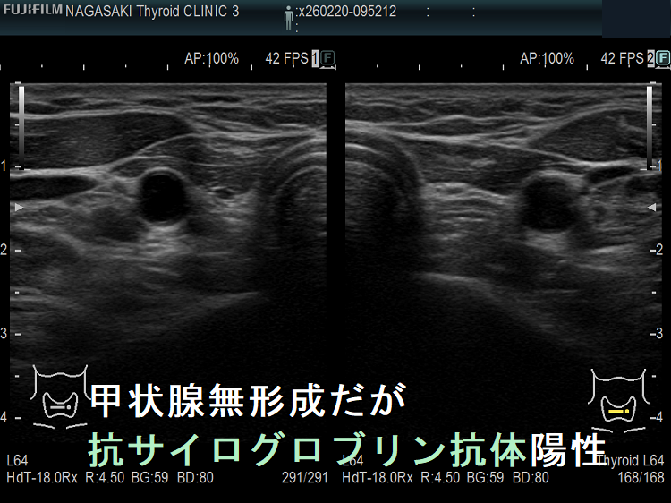 甲状腺無形成だが抗サイログロブリン抗体陽性 甲状腺無形成だが抗サイログロブリン抗体陽性