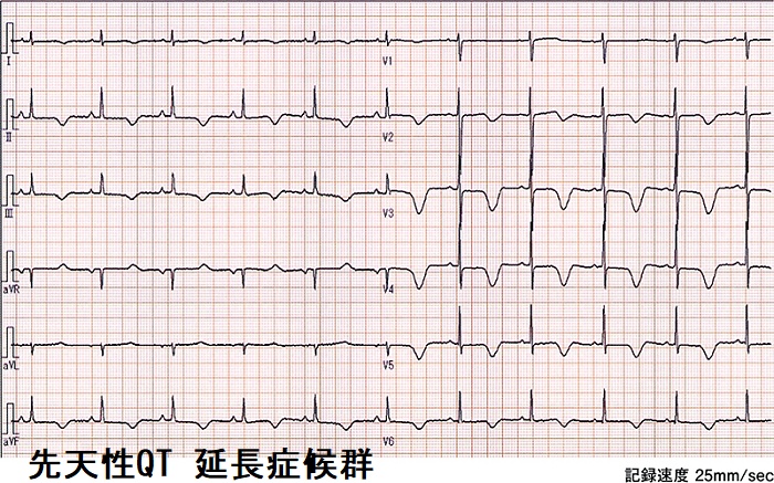 先天性QT 延長症候群 先天性QT 延長症候群