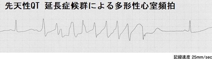 先天性QT 延長症候群による多形性心室頻拍 先天性QT 延長症候群による多形性心室頻拍