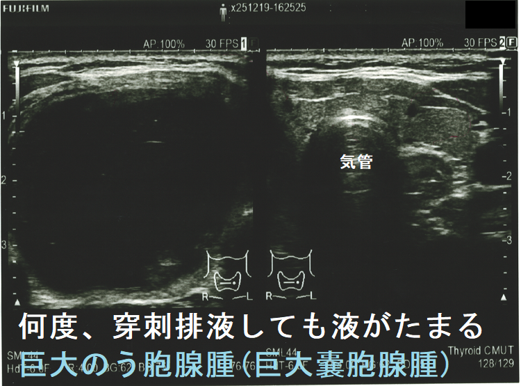 何度、穿刺排液しても液がたまる巨大のう胞腺腫(巨大嚢胞腺腫)(水平断) 何度、穿刺排液しても液がたまる巨大のう胞腺腫(巨大嚢胞腺腫)(水平断)