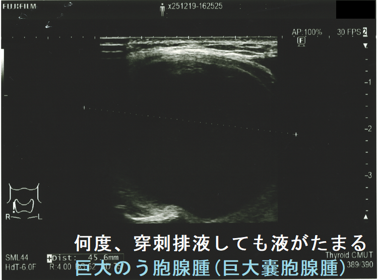 何度、穿刺排液しても液がたまる巨大のう胞腺腫(巨大嚢胞腺腫)(矢状断) 何度、穿刺排液しても液がたまる巨大のう胞腺腫(巨大嚢胞腺腫)(矢状断)
