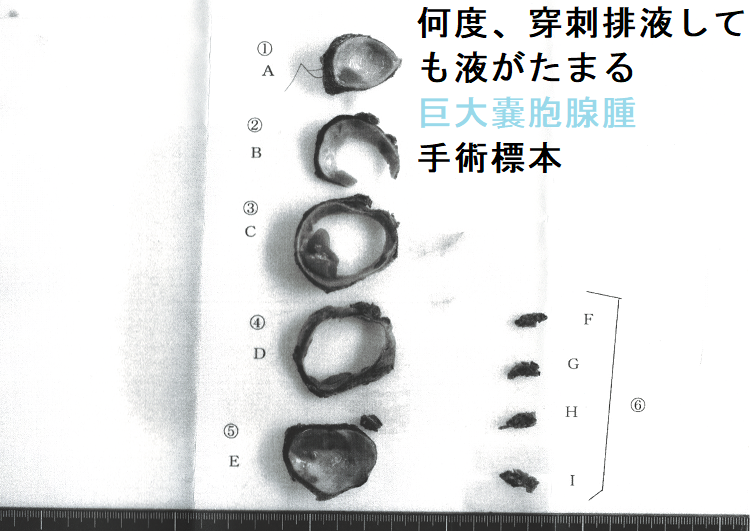 何度、穿刺排液しても液がたまる巨大のう胞腺腫(巨大嚢胞腺腫) 手術標本3 何度、穿刺排液しても液がたまる巨大のう胞腺腫(巨大嚢胞腺腫) 手術標本3
