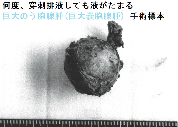 何度、穿刺排液しても液がたまる巨大のう胞腺腫(巨大嚢胞腺腫) 手術標本1 何度、穿刺排液しても液がたまる巨大のう胞腺腫(巨大嚢胞腺腫) 手術標本1