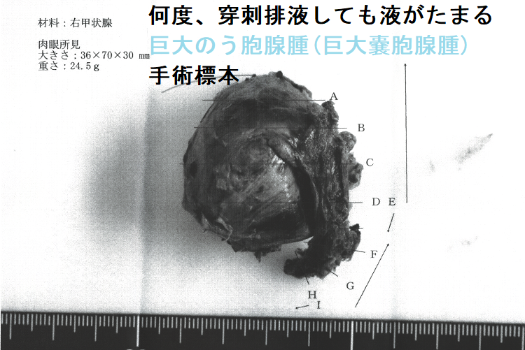 何度、穿刺排液しても液がたまる巨大のう胞腺腫(巨大嚢胞腺腫) 手術標本2 何度、穿刺排液しても液がたまる巨大のう胞腺腫(巨大嚢胞腺腫) 手術標本2
