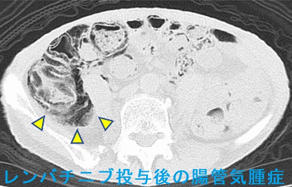 レンバチニブ投与後14週間で見つかった上行結腸の腸管気腫症 レンバチニブ投与後14週間で見つかった上行結腸の腸管気腫症