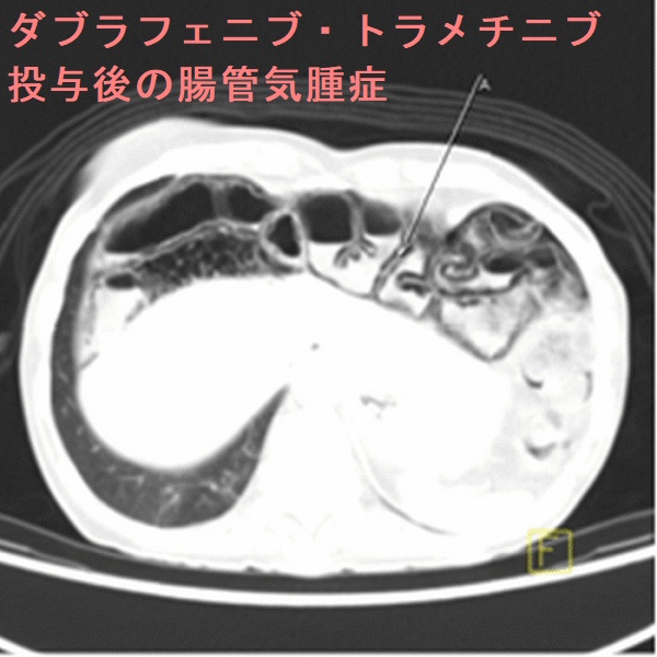 甲状腺乳頭癌肺・骨転移に対するダブラフェニブ・トラメチニブ投与後4カ月で見つかった腸管気腫症 甲状腺乳頭癌肺・骨転移に対するダブラフェニブ・トラメチニブ投与後4カ月で見つかった腸管気腫症