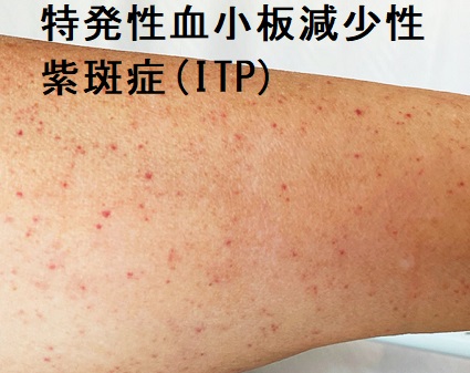特発性・免疫性血小板減少性紫斑症(ITP)