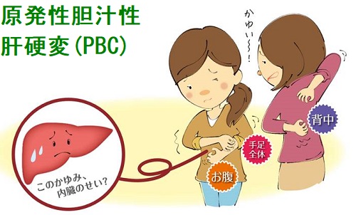 原発性胆汁性肝硬変(PBC)