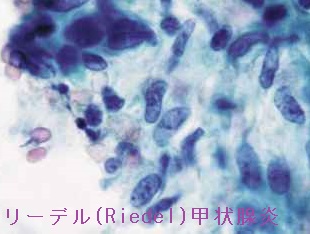 リーデル(Riedel)甲状腺炎 細胞診