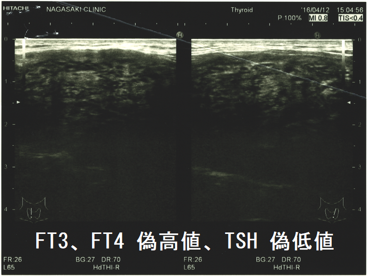 FT3、FT4 偽高値、TSH 偽低値(矢状断) FT3、FT4 偽高値、TSH 偽低値(矢状断)