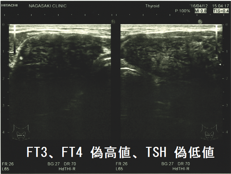 FT3、FT4 偽高値、TSH 偽低値 (水平断) FT3、FT4 偽高値、TSH 偽低値 (水平断)